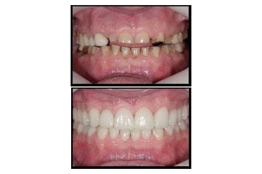Before and After Full Mouth Rehabilitation Image